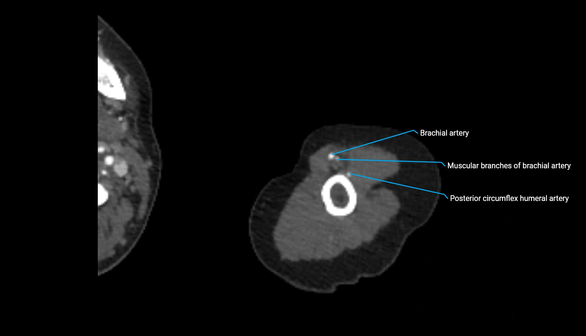 CTA upper limb axial cross sectional anatomy labelled image 294 (2).webp